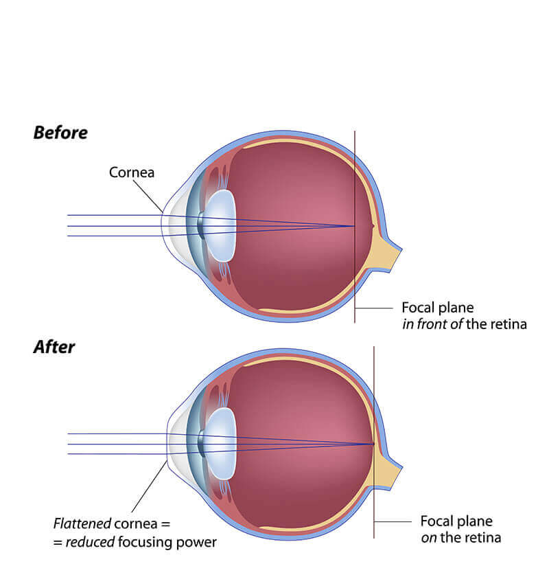Side Effects Of A Laser Eye Surgery