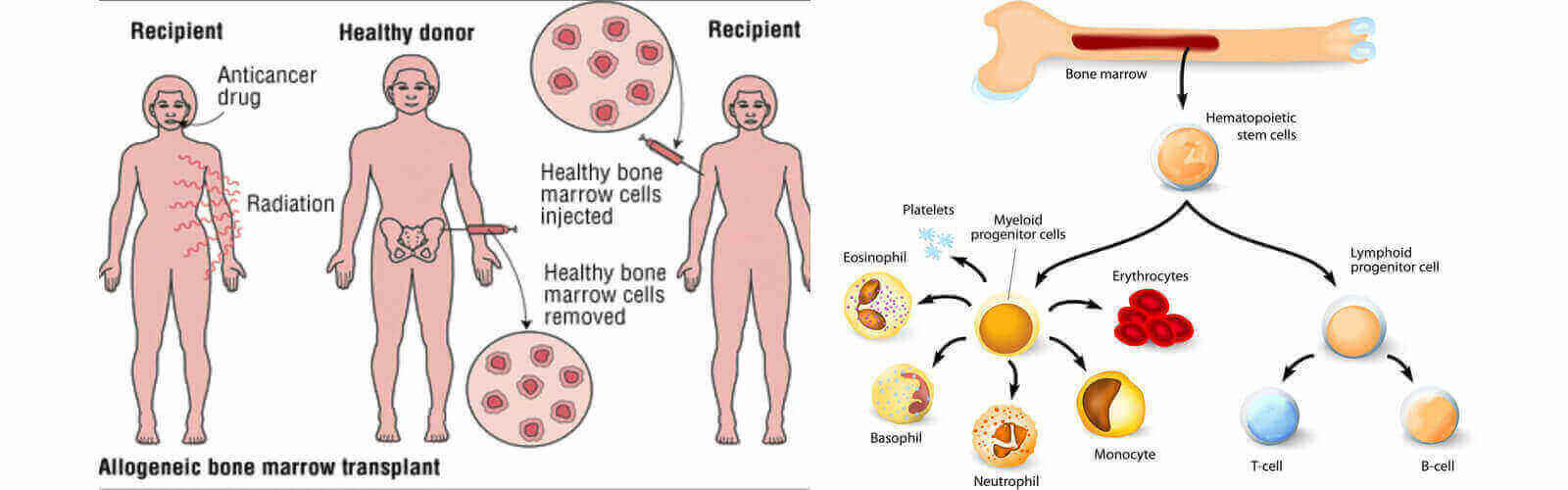 allogeneic bone marrow transplant
