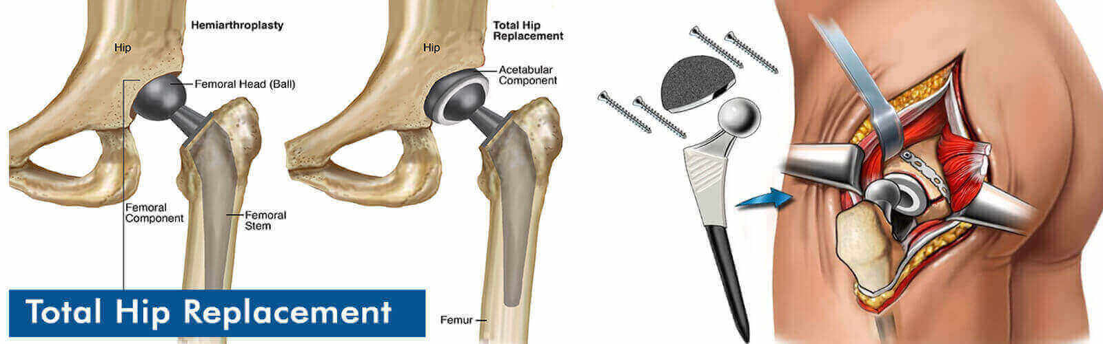 Hip Replacement Surgery Or Hip Resurfacing In Canada, Hip Replacement  Surgery Or Hip Resurfacing Hospital Canada